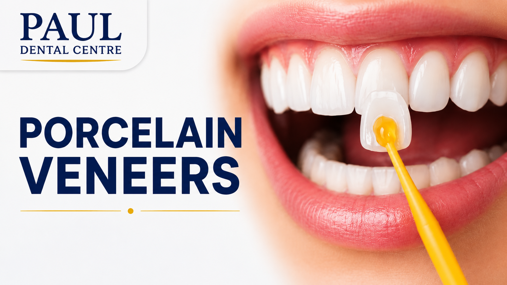Porcelain Veneers